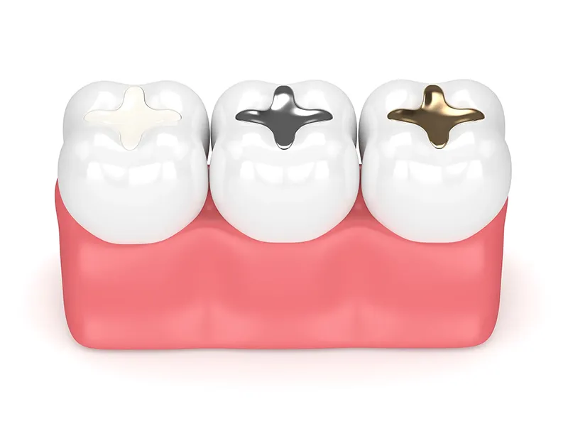 Dental fillings Dental fillings