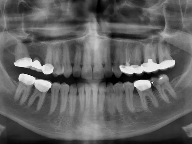 Dental X-ray Dental X-ray