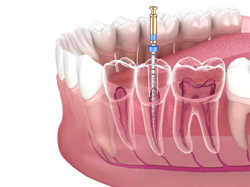 Root canal treatment Root canal treatment