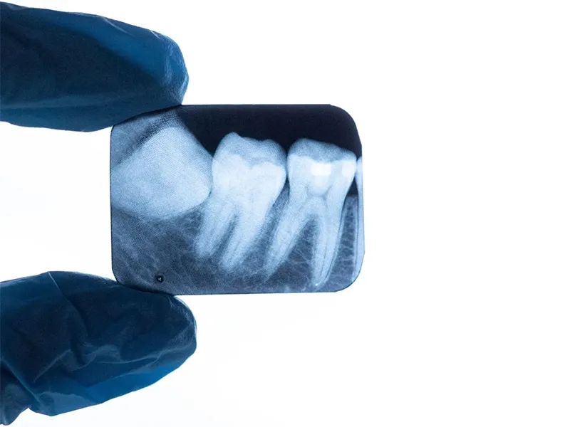 Wisdom tooth extraction Wisdom tooth extraction