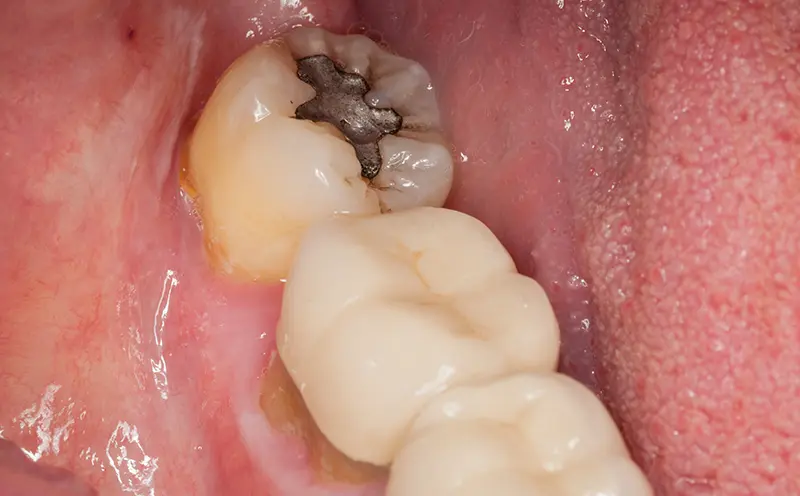 Amalgam Filling