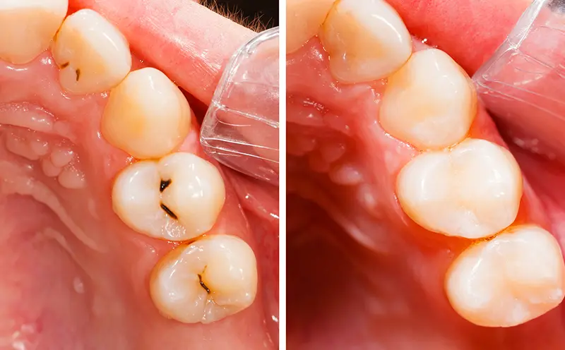 Composite Fillings