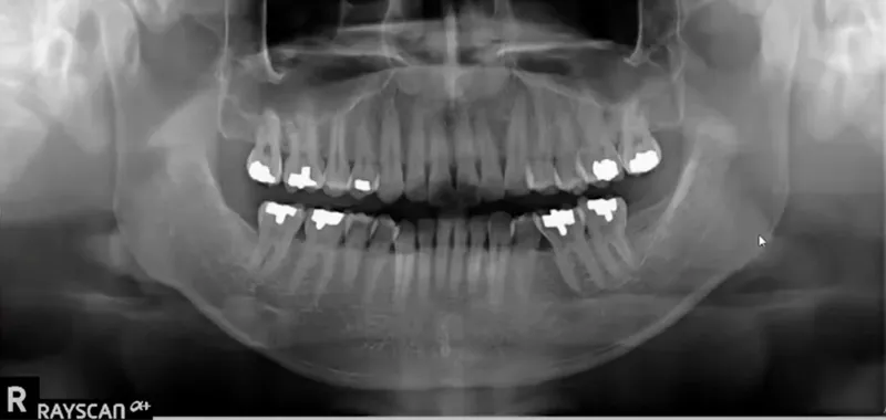 CBCT Scan CBCT Scan
