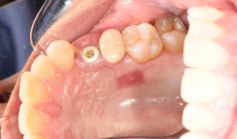 Dental-Paradiso - Case-Study-Soft Tissue Grafting + Dental Implants-Implant placement Implant placement and provisionalization