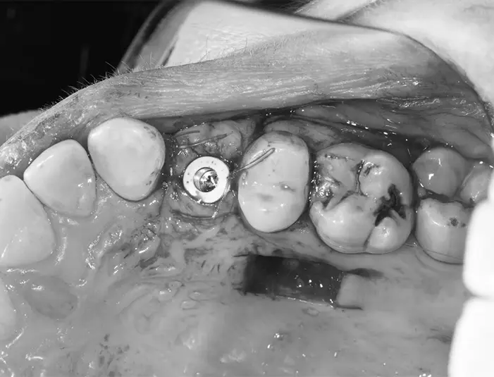 Dental-Paradiso - Case-Study-Soft Tissue Grafting + Dental Implants-harvesting-the-graft Harvesting the graft (donor site)