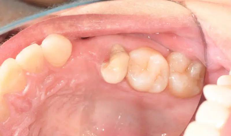 Dental-Paradiso - Case-Study-Soft Tissue Grafting + Dental Implants-preparation Preparation and planning