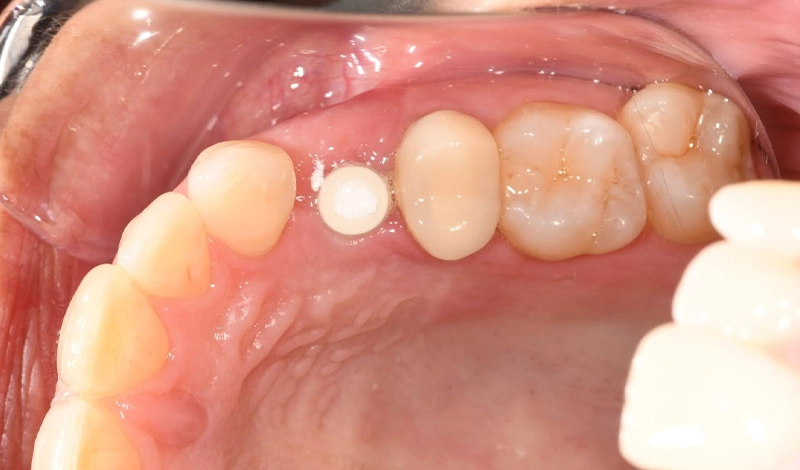 Dental-Paradiso - Case-Study-Soft Tissue Grafting + Dental Implants-provisionalization Implant placement and provisionalization