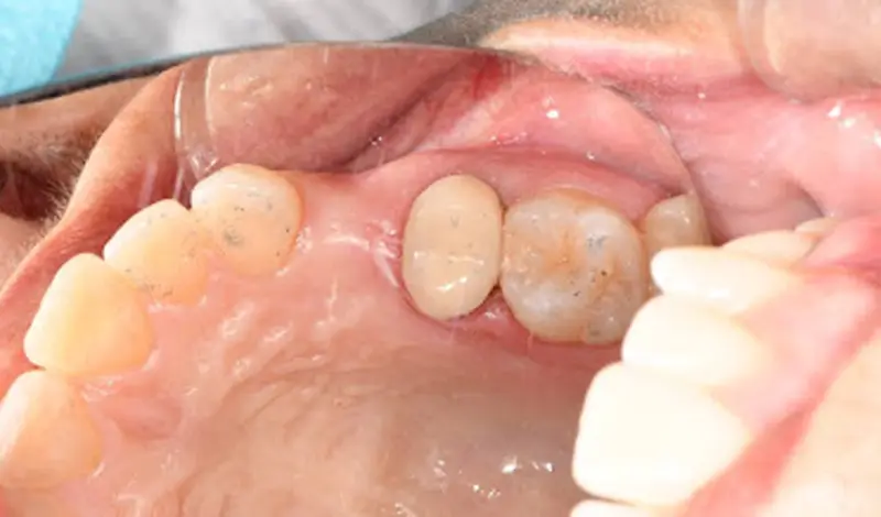 Dental-Paradiso - Case-Study-Soft Tissue Grafting + Dental Implants-restoration Preparation and planning