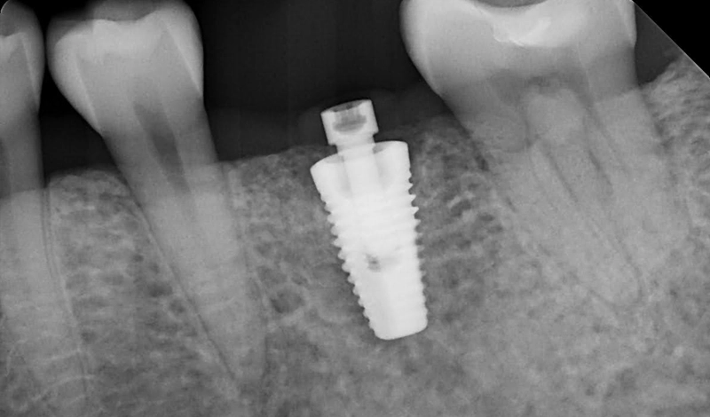 Dental-Paradiso - Case-Study-Soft Tissue Grafting + Dental Implants-x-ray-scan-implant-2 X-ray scans implant