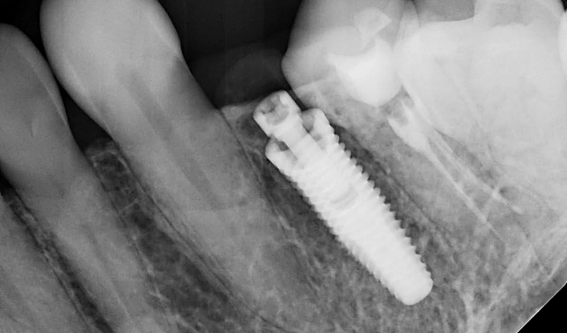 Dental-Paradiso - Case-Study-Soft Tissue Grafting + Dental Implants-x-ray-scan-implant X-ray scans implant