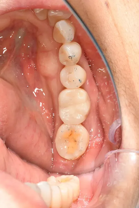Implant placement Implant placement