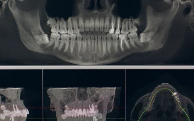 Is it time? The clear signs you need your wisdom teeth out