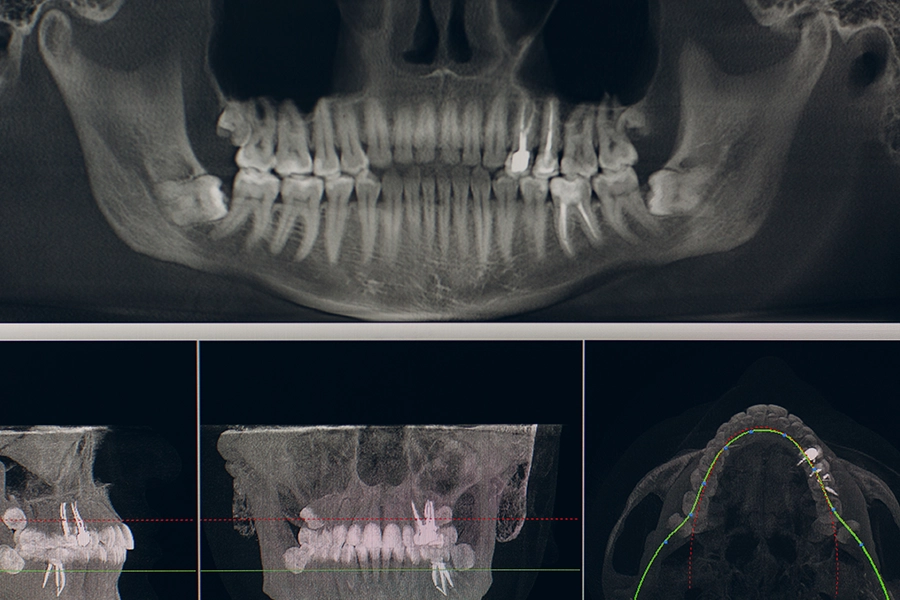 CBCT Scan Wisdom Tooth