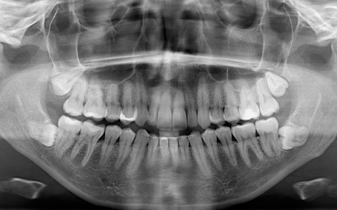 X-ray Scan