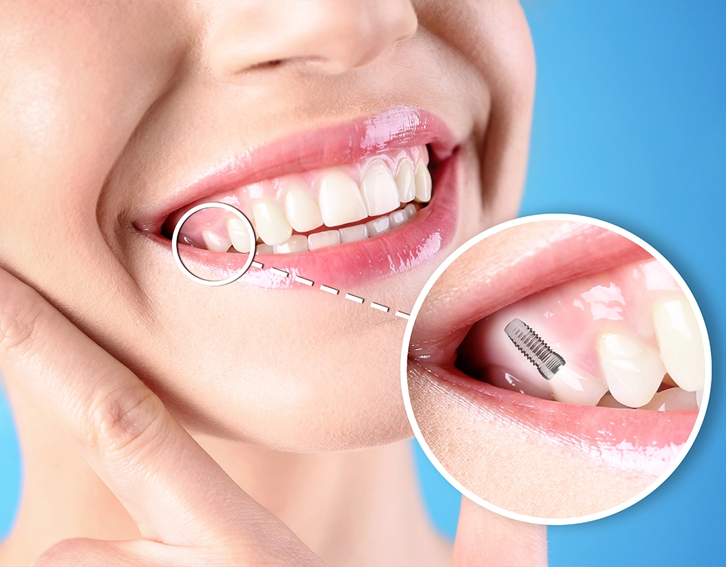 Dental Implant Care