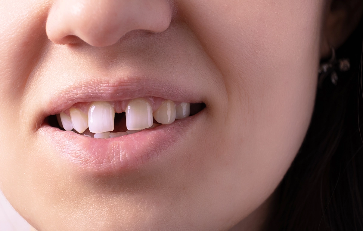 Professional options for closing a front tooth gap