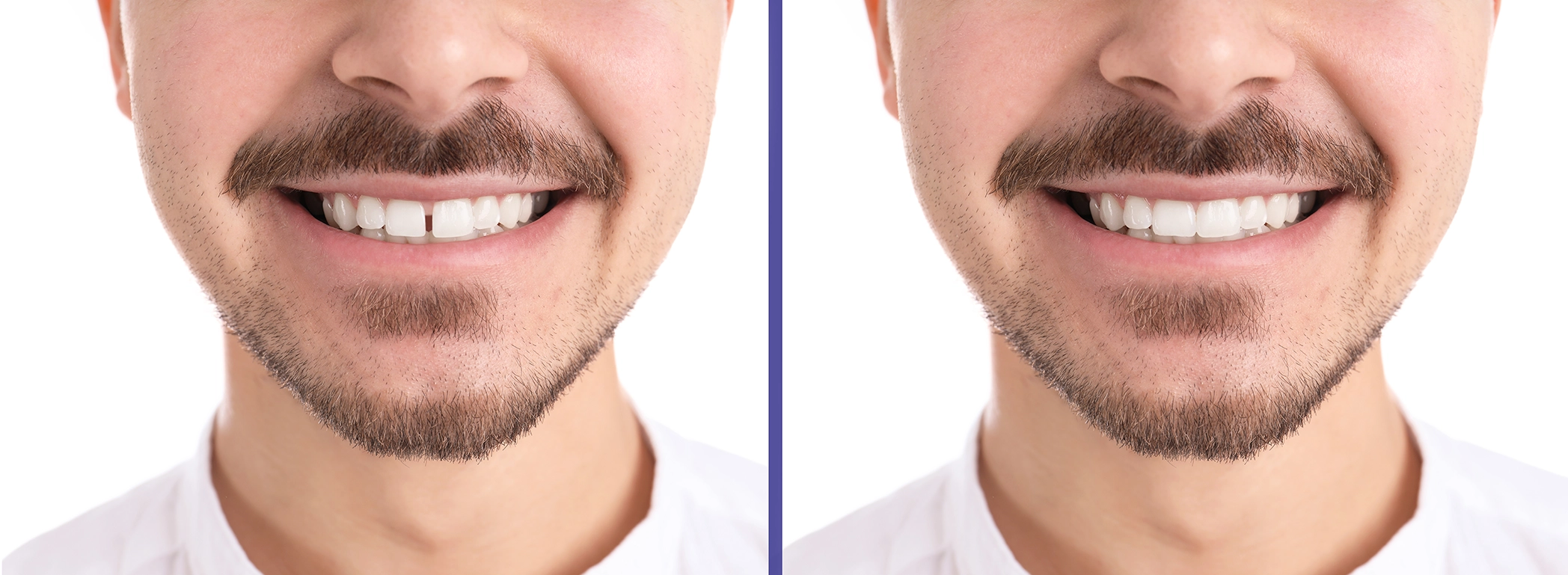 Professional options for closing a front tooth gap