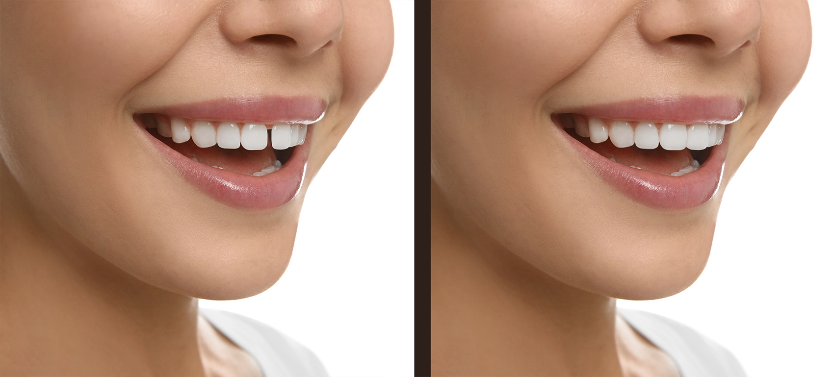Professional options for closing a front tooth gap