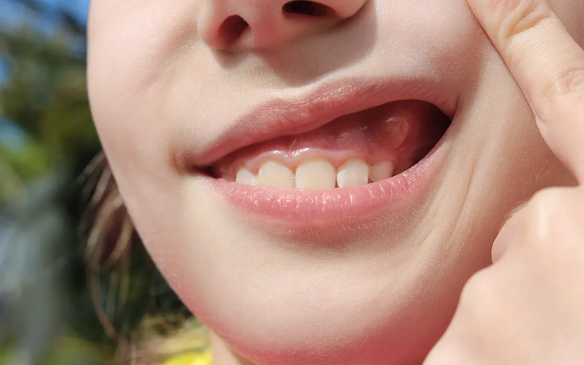 Why do gums suddenly look different