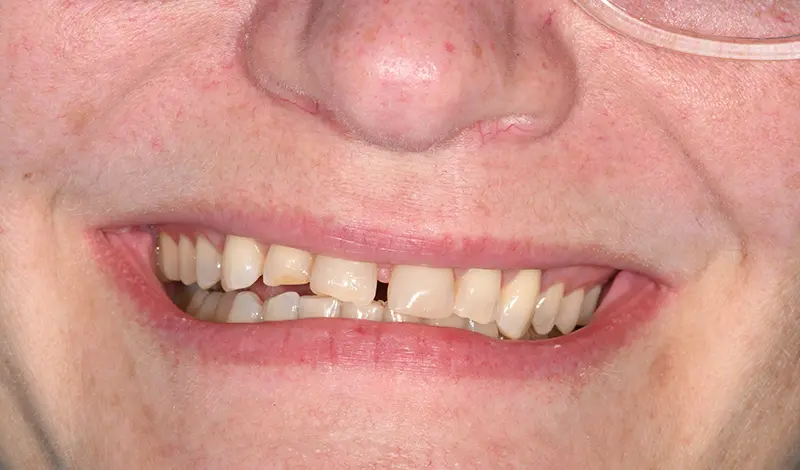 Clear Aligners & 3D Veneers - before