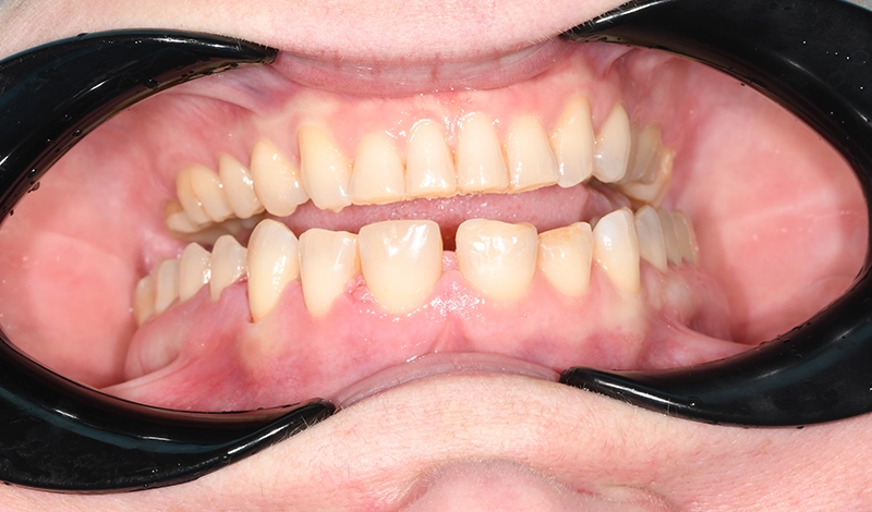 Clear Aligners & 3D Veneers - after