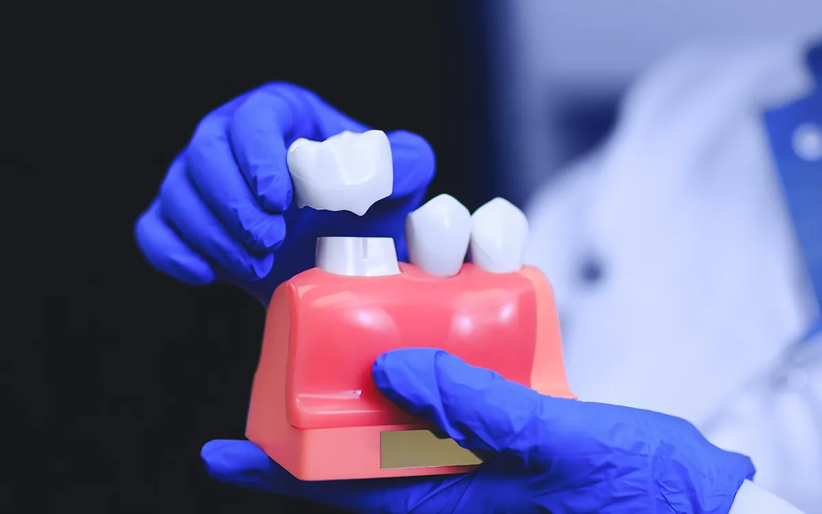 Why older dental crowns sometimes looked fake